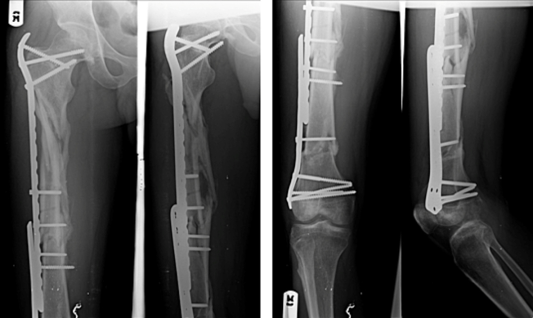 微创双钢板桥接固定治疗复杂股骨骨折！