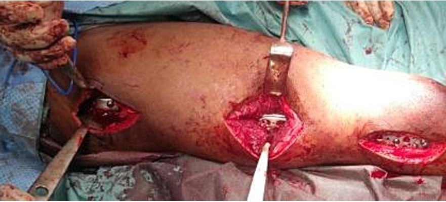 微创双钢板桥接固定治疗复杂股骨骨折！