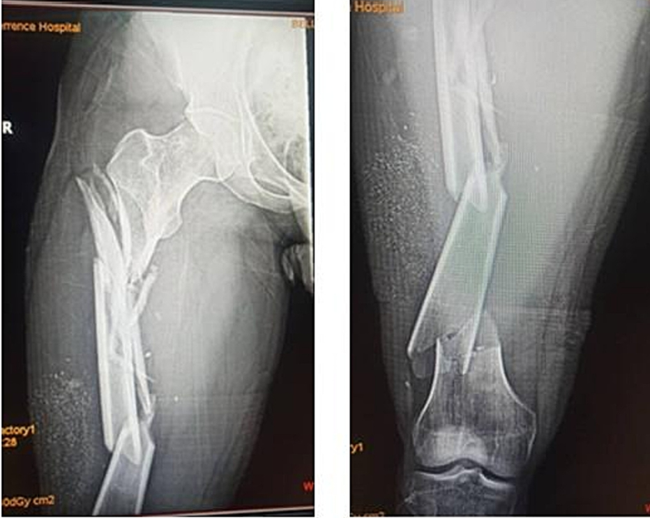 微创双钢板桥接固定治疗复杂股骨骨折！