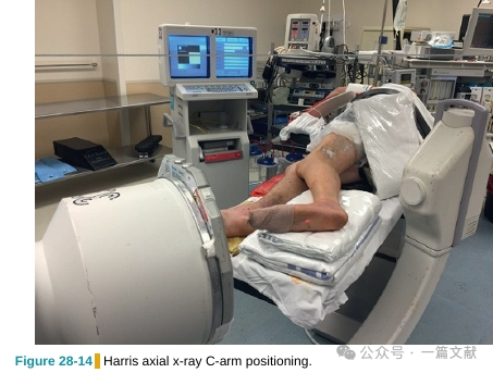 跟骨骨折内固定术中透视技巧