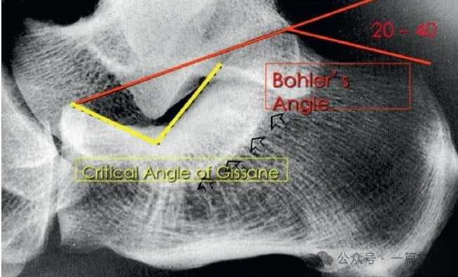 跟骨骨折内固定术中透视技巧