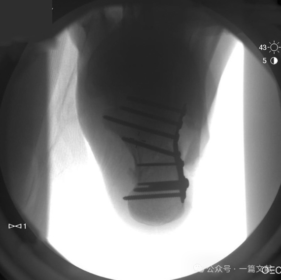 跟骨骨折内固定术中透视技巧