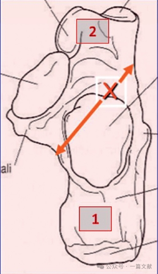 跟骨骨折内固定术中透视技巧
