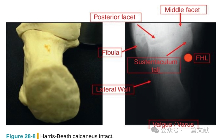 跟骨骨折内固定术中透视技巧