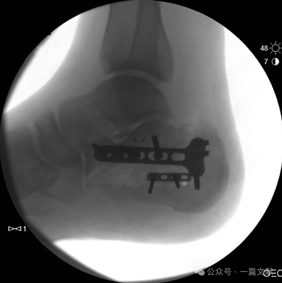 跟骨骨折内固定术中透视技巧