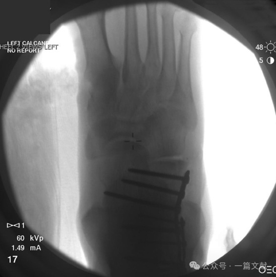 跟骨骨折内固定术中透视技巧