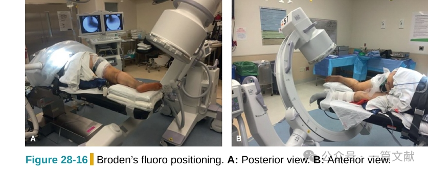 跟骨骨折内固定术中透视技巧