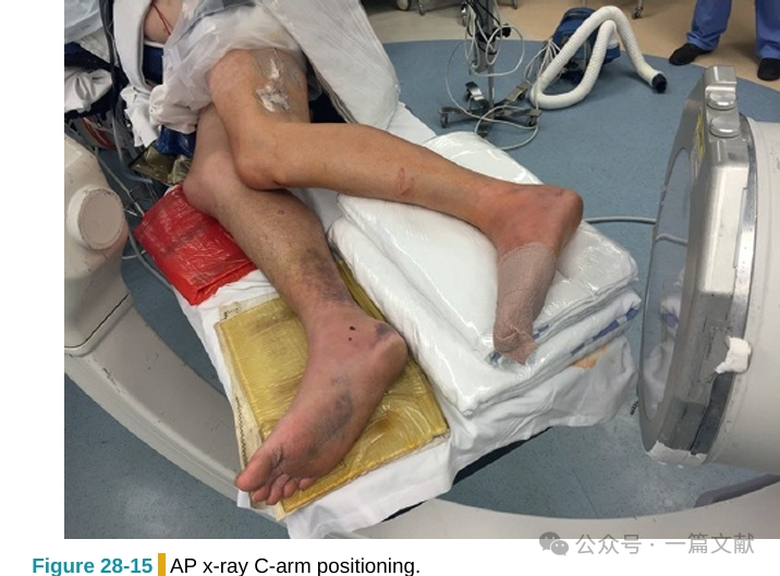 跟骨骨折内固定术中透视技巧