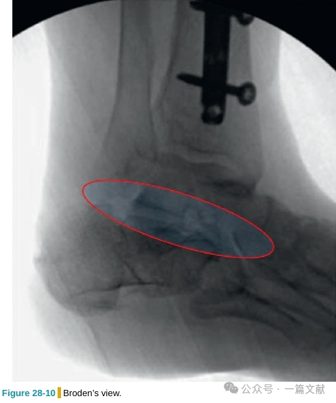 跟骨骨折内固定术中透视技巧