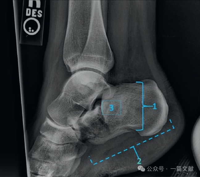 跟骨骨折内固定术中透视技巧