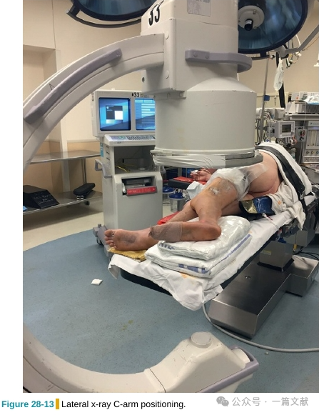 跟骨骨折内固定术中透视技巧