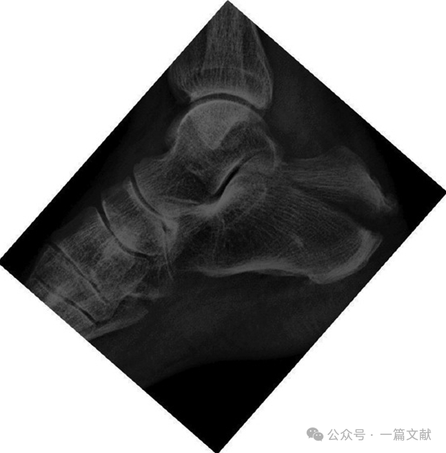 跟骨骨折内固定术中透视技巧