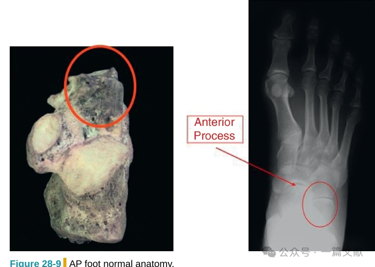跟骨骨折内固定术中透视技巧