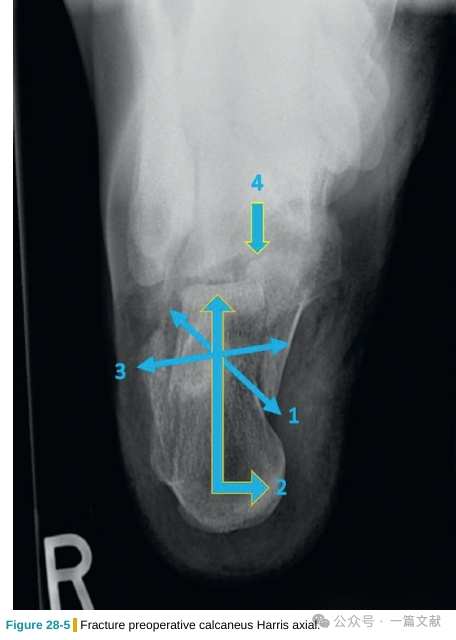 跟骨骨折内固定术中透视技巧