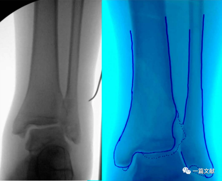 术中如何判断患肢力线是否恢复？骨折是否解剖复位？