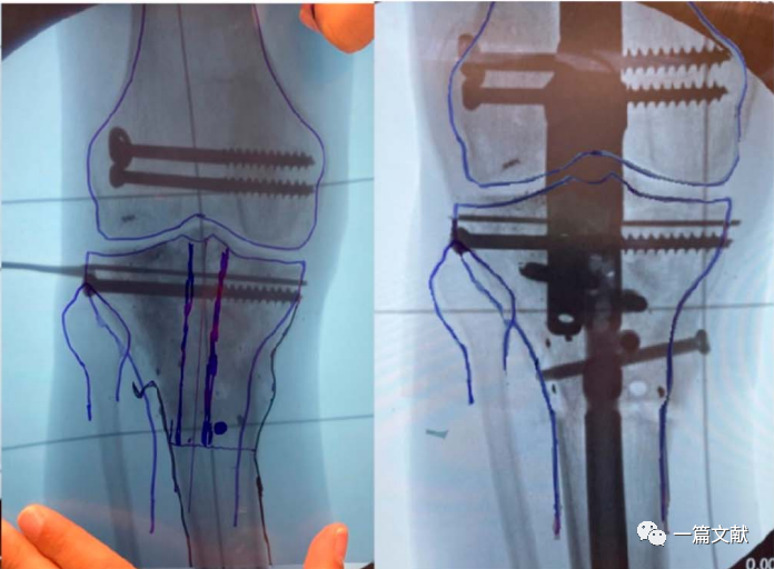 术中如何判断患肢力线是否恢复？骨折是否解剖复位？