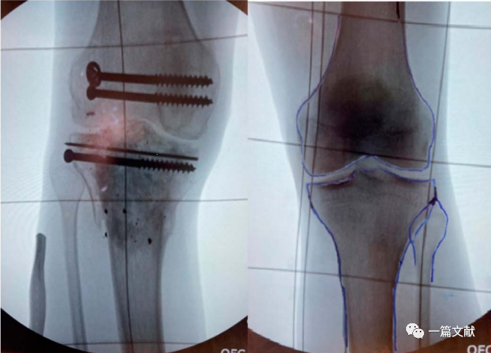 术中如何判断患肢力线是否恢复？骨折是否解剖复位？