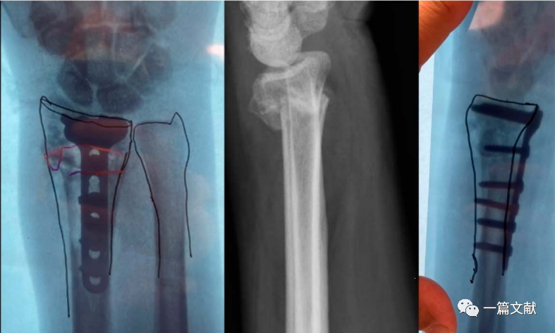 术中如何判断患肢力线是否恢复？骨折是否解剖复位？