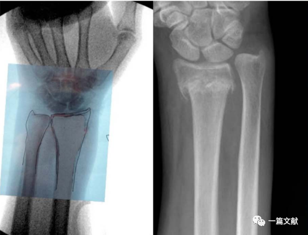 术中如何判断患肢力线是否恢复？骨折是否解剖复位？