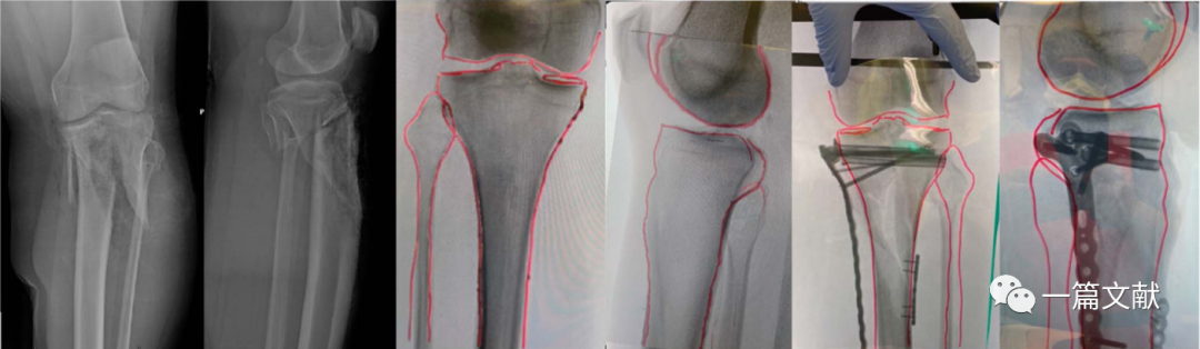 术中如何判断患肢力线是否恢复？骨折是否解剖复位？