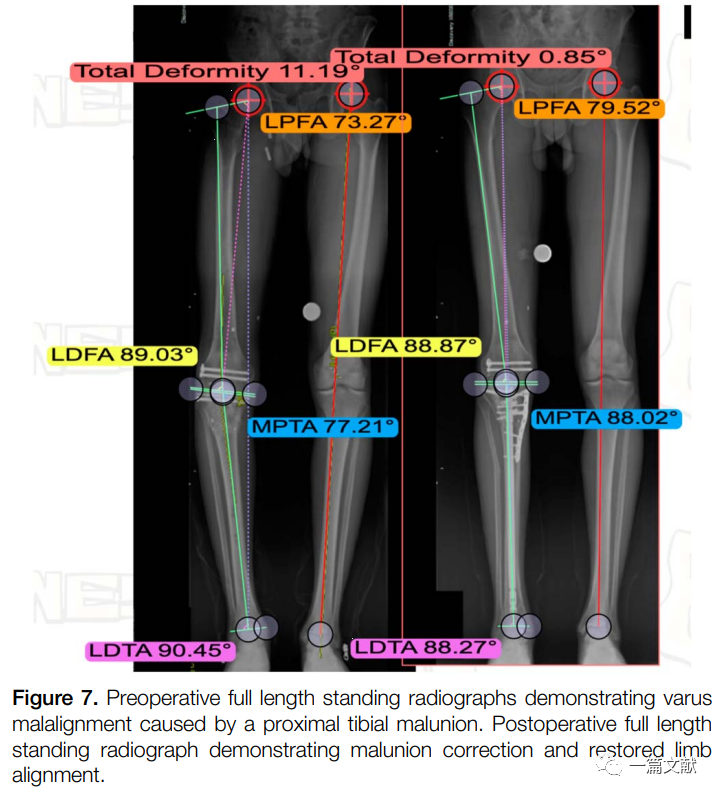 术中如何判断患肢力线是否恢复？骨折是否解剖复位？