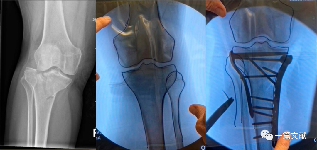 术中如何判断患肢力线是否恢复？骨折是否解剖复位？