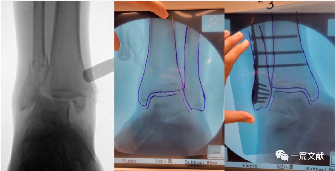 术中如何判断患肢力线是否恢复？骨折是否解剖复位？
