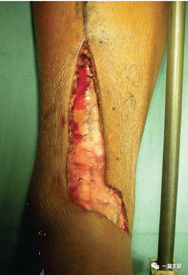 Pilon骨折常用入路详解（Harborview