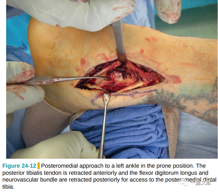 Pilon骨折常用入路详解（Harborview