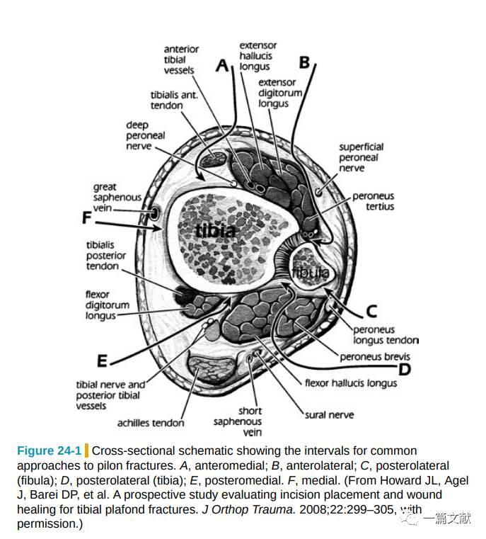 Pilon骨折常用入路详解（Harborview