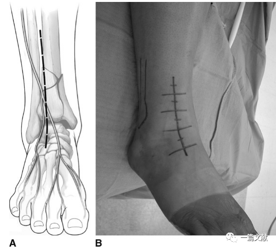 Pilon骨折常用入路详解（Harborview