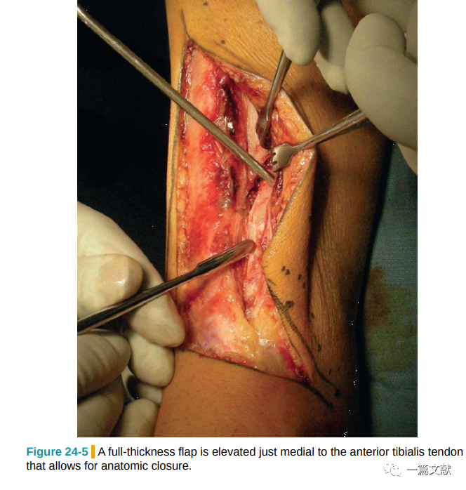 Pilon骨折常用入路详解（Harborview
