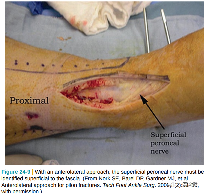 Pilon骨折常用入路详解（Harborview