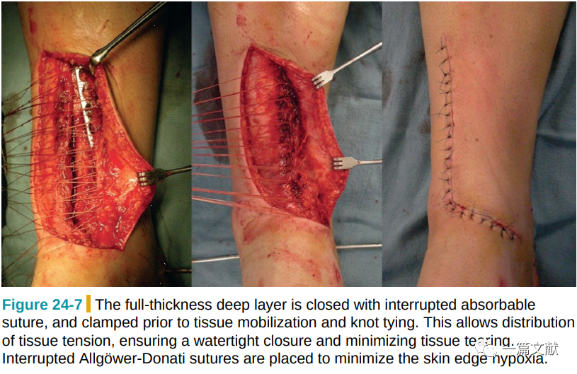 Pilon骨折常用入路详解（Harborview