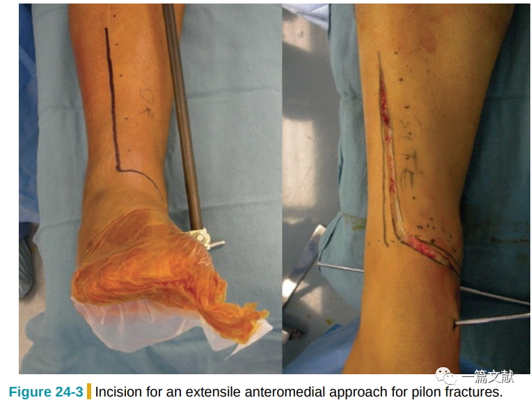 Pilon骨折常用入路详解（Harborview