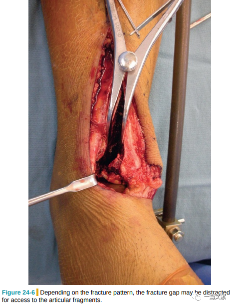 Pilon骨折常用入路详解（Harborview