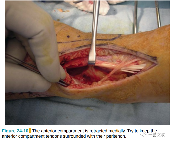 Pilon骨折常用入路详解（Harborview