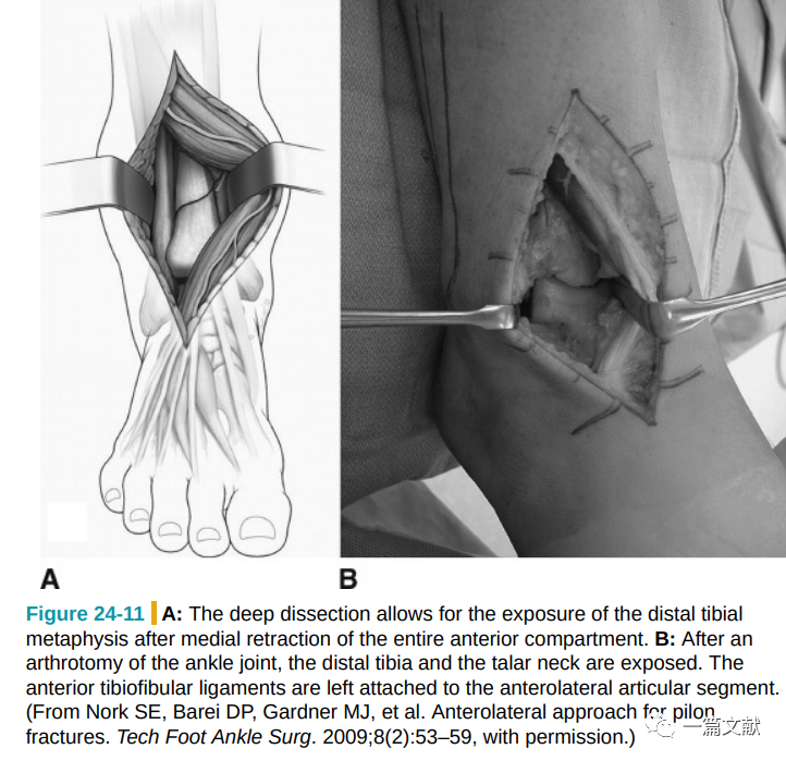 Pilon骨折常用入路详解（Harborview