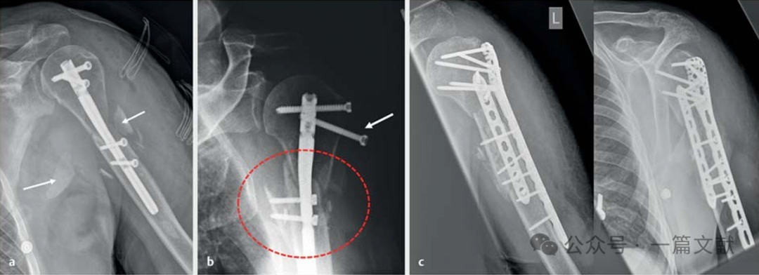 上肢骨折的双钢板固定技术