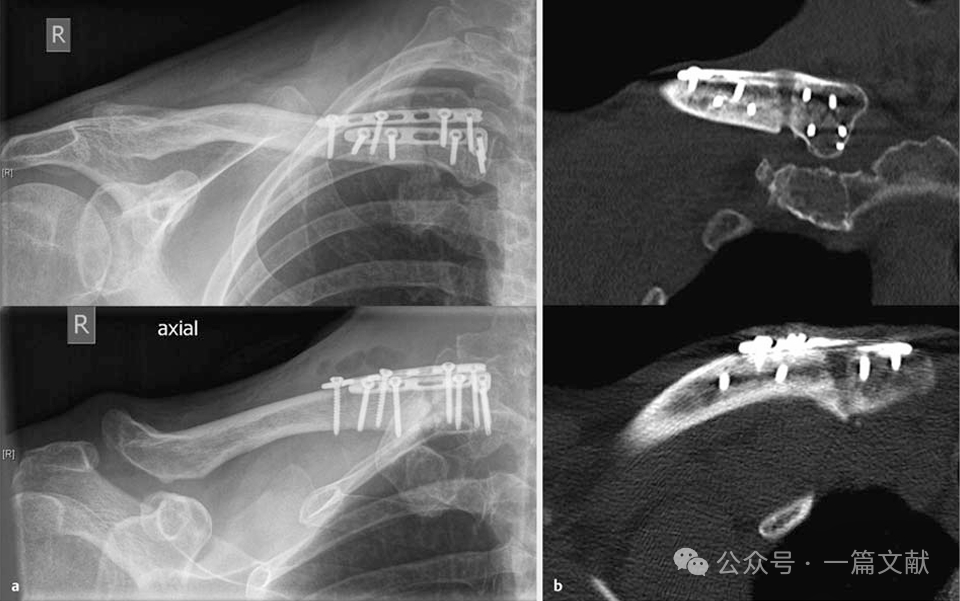 上肢骨折的双钢板固定技术