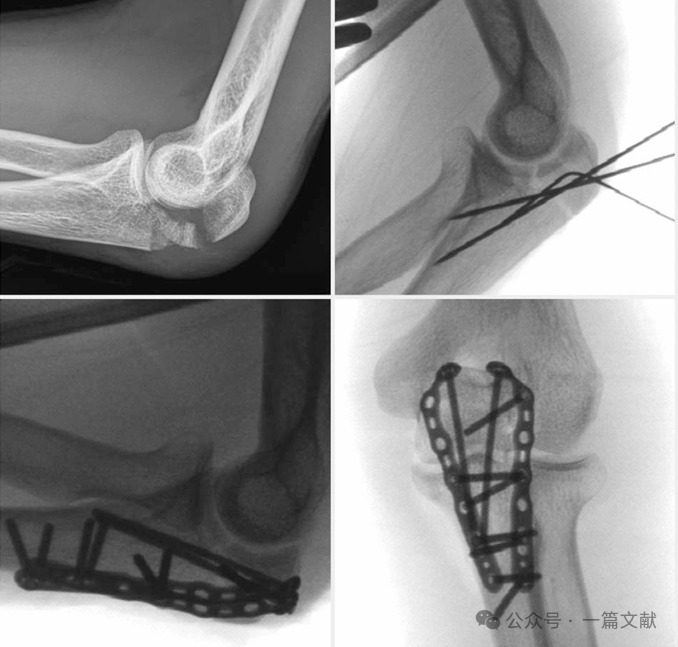 上肢骨折的双钢板固定技术