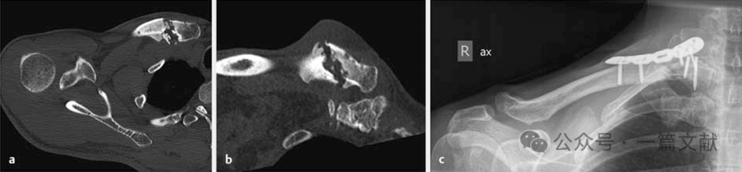 上肢骨折的双钢板固定技术