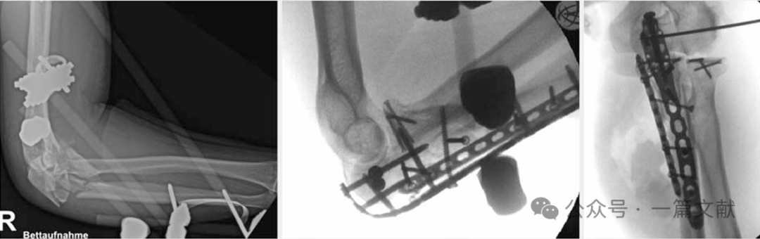 上肢骨折的双钢板固定技术