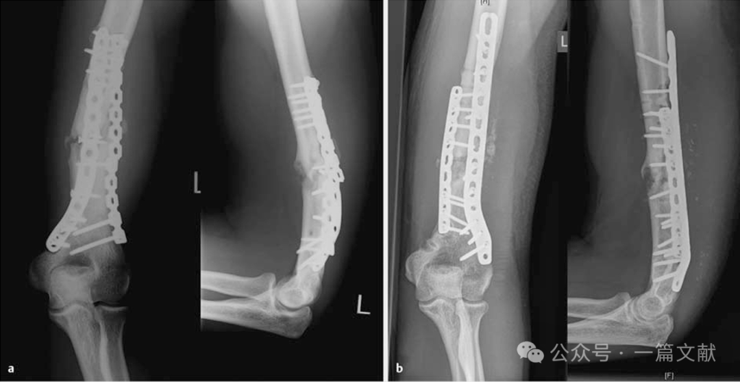 上肢骨折的双钢板固定技术