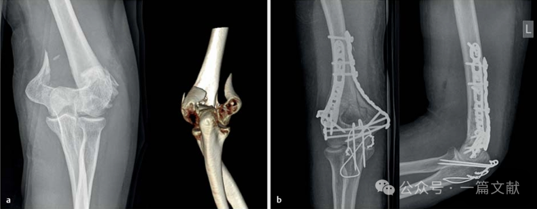 上肢骨折的双钢板固定技术