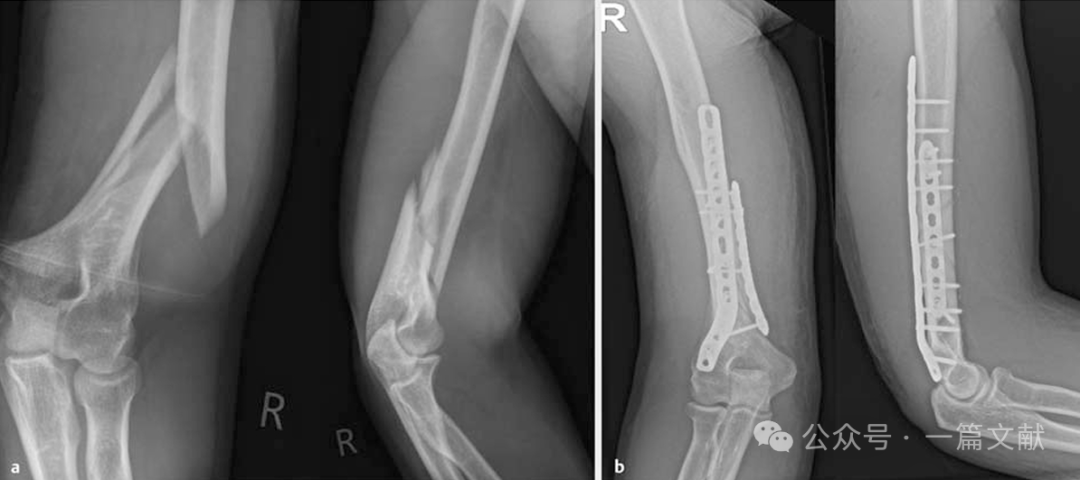 上肢骨折的双钢板固定技术