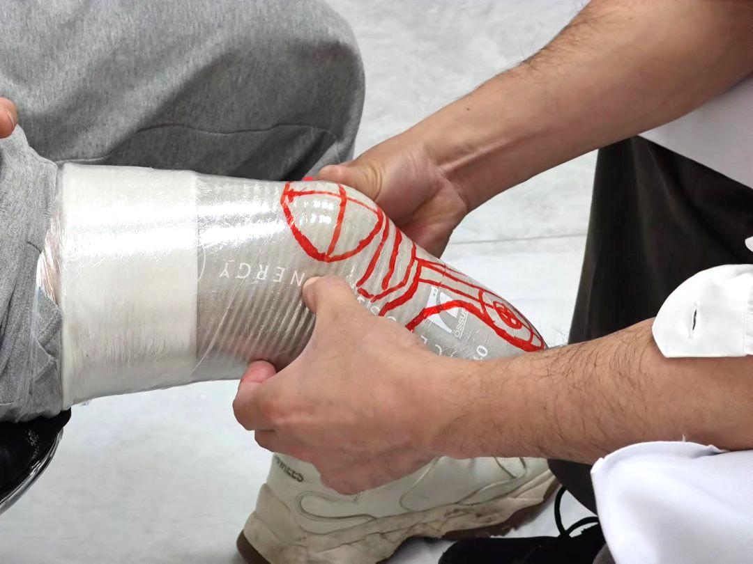 夏天穿假肢，残肢瘙痒红肿怎么办？