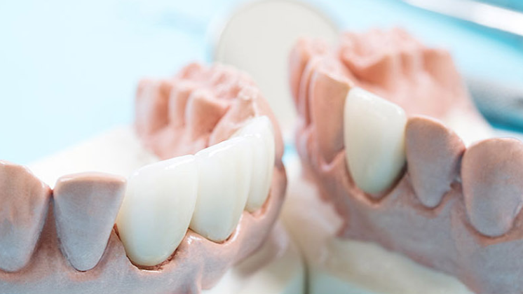 都说全瓷牙好,究竟好在哪里？