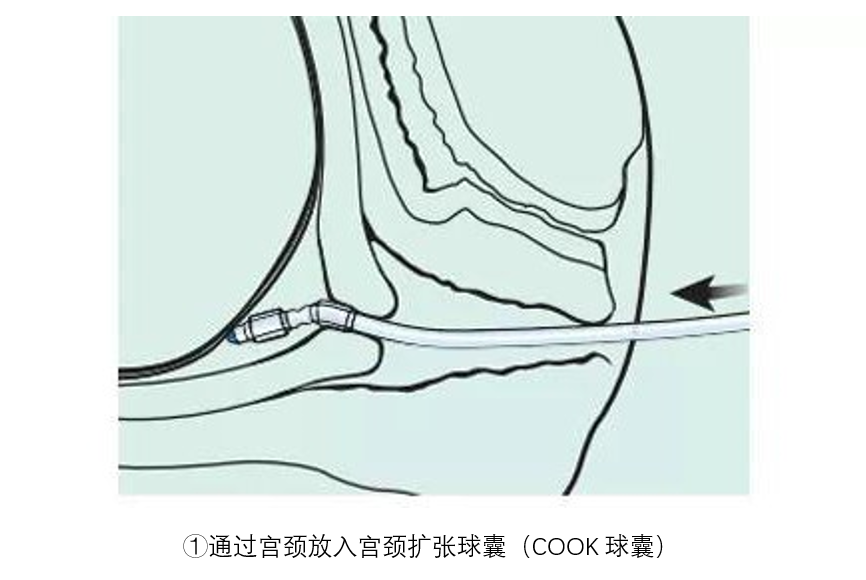 什么是cook球囊宫颈COOK水囊——让顺产更顺利-上海聚慕医疗器械有限公司