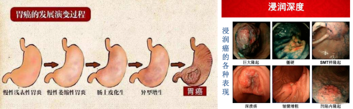 进口胃镜都有哪些品牌内镜中的“福尔摩斯”——日本富士ELUXEO 7000高清电子胃肠镜！_https://www.jmylbn.com_新闻资讯_第16张